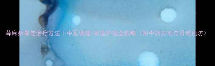 荨麻疹最佳治疗方法中医调理家庭护理全攻略附中药方剂与日常预防